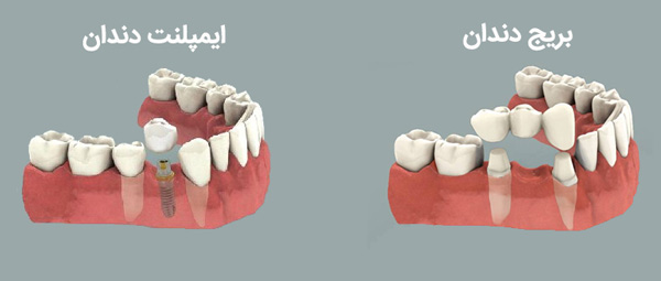 مقایسه ایمپلنت و بریج: کدام گزینه برای شما مناسب‌تر است؟