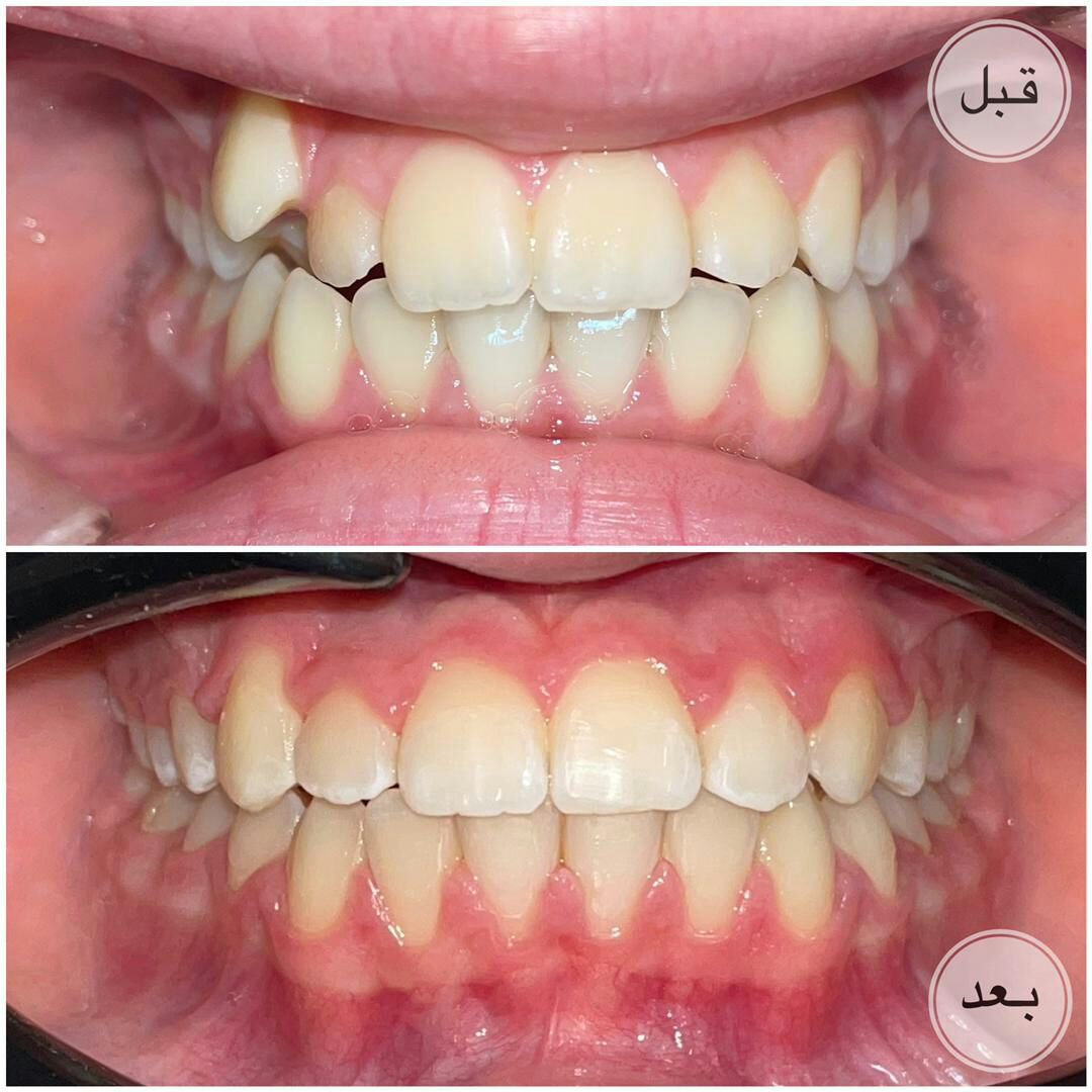 ارتودنسی نامرئی - قبل و بعد